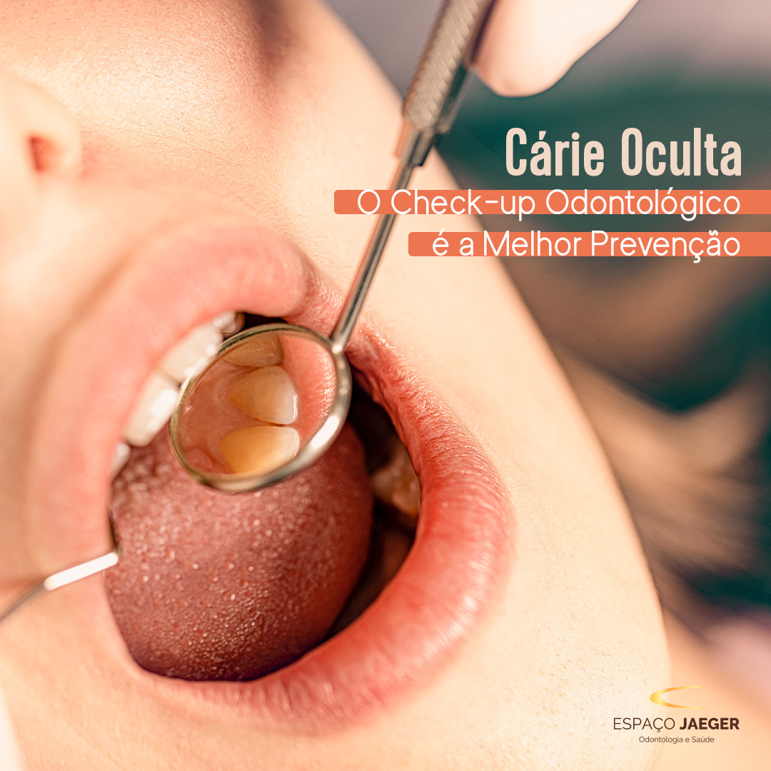 Cárie Oculta: O check-up odontológico é a melhor prevenção