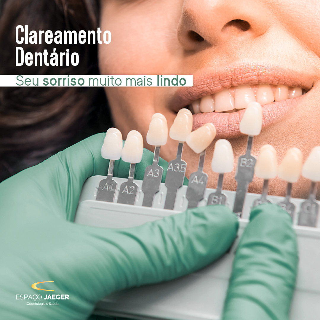 Clareamento dental em Brasília: devo clarear meus dentes?